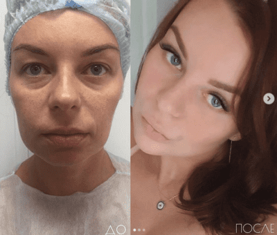 Ультразвуковая липосакция