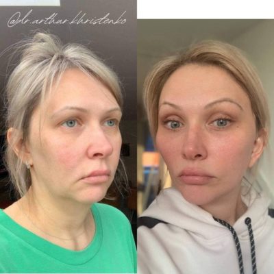 Безоперационное омоложение кожи лица и шеи