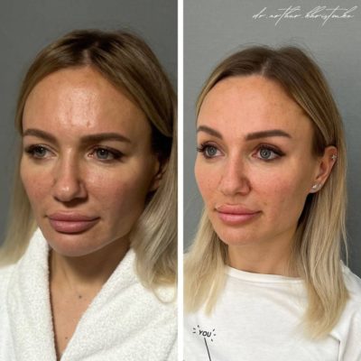 Эндоскопический лифтинг лба